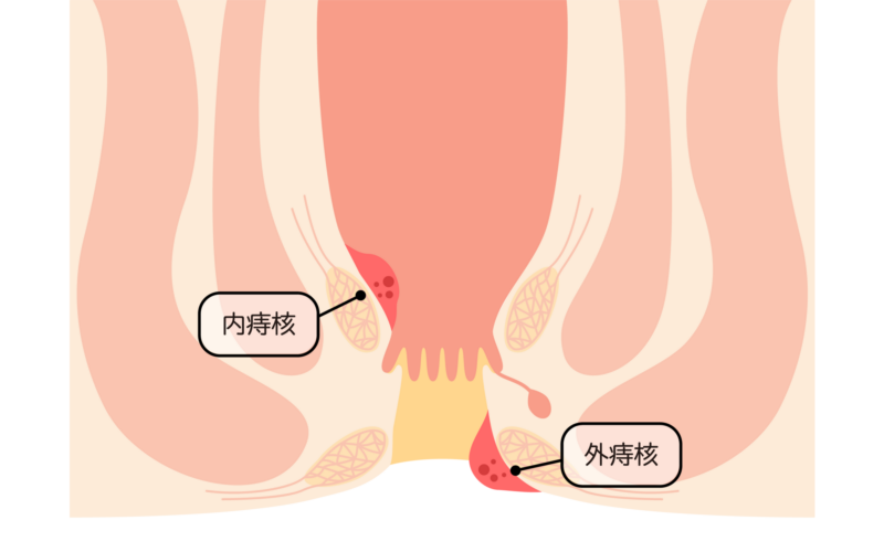 いぼ痔（内痔核・外痔核）