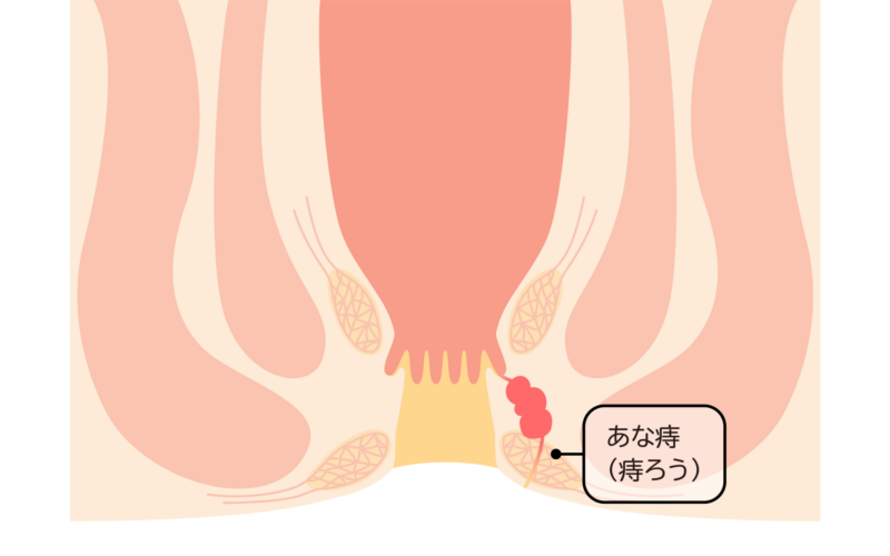 痔ろう（あな痔）とは