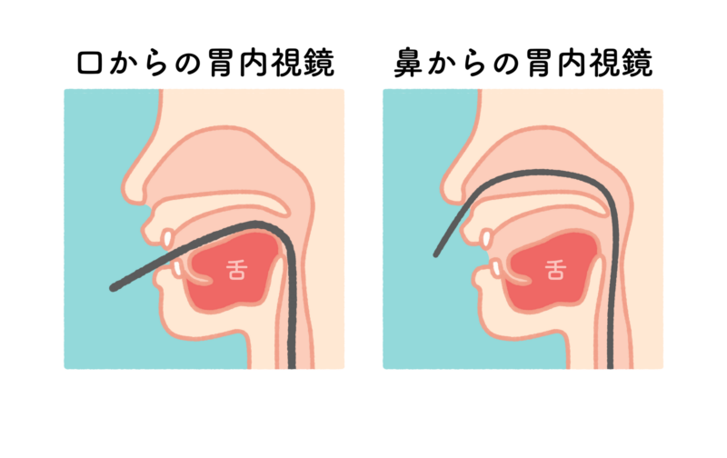 経口　経鼻　内視鏡検査